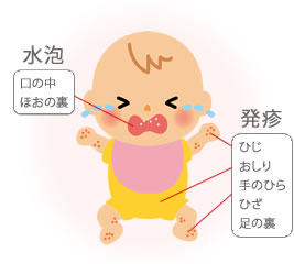 水泡（口の中、ほおの裏）、発疹（ひじ、おしり、手のひら、ひざ、足の裏）