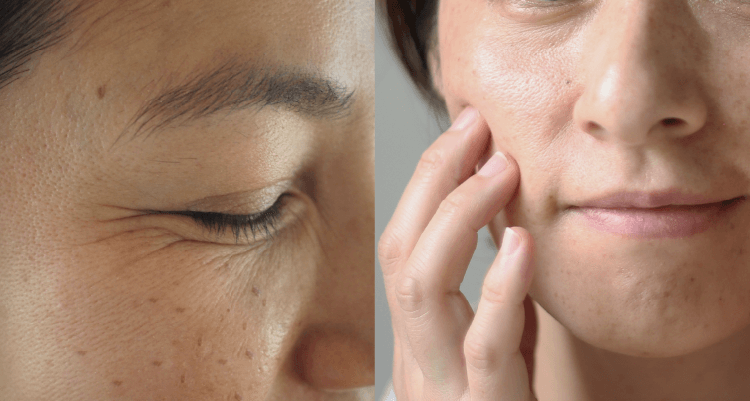 年齢サインの肌悩み